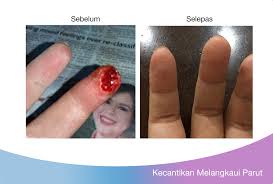 Habislah berparut pipi gebu aku ni. Parut Saya Semakin Pudar Kulit Lebih Cantik Terima Kasih