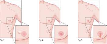 Harris jr, lippman me, morrow m, osborne ck, eds. Male Breast Cancer Signs Symptoms Treatment