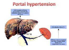 Symptoms include varices, rectal bleeding, vomiting blood. Portal Hypertension