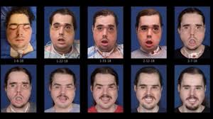 The superstar took home three awards and performed alongside kenny g at the show and surprised fans by fully wrapping his face during his many appearances. See The Remarkable Recovery Progression Of Face Transplant Patient Cameron Underwood Of Yuba City Youtube