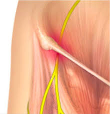 These nerve blocks can help in the diagnosis of chronic hip/thigh pain. Meralgia Paresthetica Treatment