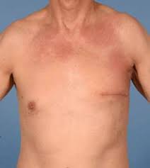A lump or swelling, which is often (but not always) painless. Left Sided Breast Cancer In A 67 Year Old Male Pre Operative Download Scientific Diagram