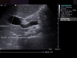 Portal Vein Stenosis In Post Liver Transplant Case Liver Stenosis Ultrasound