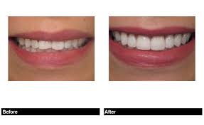 Beverly Hills Porcelain Veneers Faqs Arthur Glosman Dds