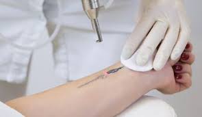Our mission is to ensure that the cost of tattoo removal is affordable for everyone who needs laser tattoo removal. 10 Best Clinics For Laser Tattoo Removal In Turkey 2021 Prices