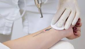 Find laser tattoos removal cost. Lfssysxc7k Awm