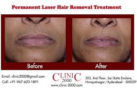 Small treatment areas, like the upper lip, may require minimal treatment sessions. Laser Hair Removal Is Best For Removing Unwanted Hair From The Face Including The Upper Lip It Uses Low Permanent Laser Hair Removal Laser Hair Hair Removal
