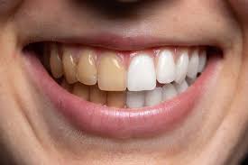 Image result for Tooth Discoloration