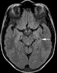 Image result for Incidental Imaging Finding