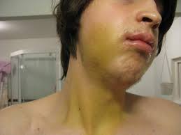 Maybe you would like to learn more about one of these? Swelling After Wisdom Teeth Removal Reddit Teethwalls