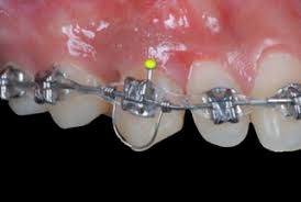 MẤT TORQUE TRONG CHỈNH NHA 🧐 Mất torque là một hỗn hợp đa yếu tố. Các lý do chính có thể gây nên mất TORQUE có thể là: - Sức cản vỏ