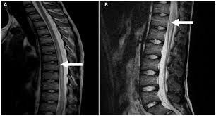 Image result for Myelitis
