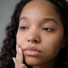 Image result for acne face