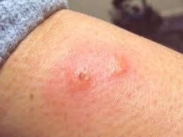 Allergic Reaction Black Ant Bites Pictures Pin On Great Ideas