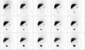 It can be congenital or acquired. 161 Biliary Atresia Radiology Key