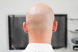 The presence of drb1*0401 and dqb1*0301, both of which are human leukocyte antigens. Was Sie Uber Alopecia Totalis Wissen Sollten Demedbook