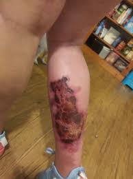 This article covers its symptoms, causes, and treatments. More Cases Of Flesh Eating Bacteria Reported News Daytona Beach News Journal Online Daytona Beach Fl