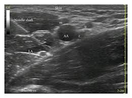 Image result for Axillary Nerve Block