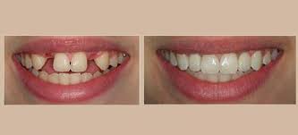 A removable partial denture (rpd) is for a partially edentulous dental patient who desires to have replacement teeth for functional or aesthetic reasons, and who cannot have a bridge. Types Of Partial Dentures Maritza O Jenkins Dmd General Dentist