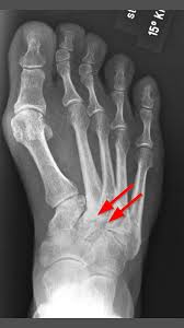 Schmerzende, steife und verformte finger: Mittelfussarthrose Ogam Orthopadie