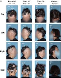 Image result for HAIR Score