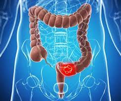 .combination chemotherapy for patients with poor prognosis advanced colorectal cancer (mrc tenesa a., dunlop m.g./ new insights into the aetiology of colorectal cancer from genomewide. Colon Cancer Symptoms Causes Prevention And Treatment