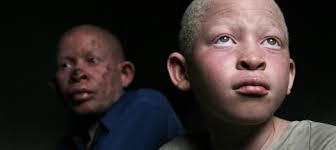 Albino vertebrates exposed to intense light typically lose photoreceptors due to apoptosis.23. Ending Albino Persecution In Africa Africa Renewal