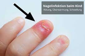 Nagelbettentzundung Bei Baby Und Kind Was Ist Zu Beachten