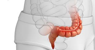 Get the facts on colon cancer (colorectal cancer) signs, symptoms, causes, prognosis, treatment information, and prevention screening through colonoscopy. Advanced Surgical Associates Colorectal Surgery I