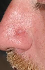 Image result for syphilis ulcer