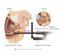 Although screenings for prostate cancer are one tool for early detecti. Know Everything About Prostate Cancer Patient Information