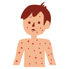 Image result for Measles