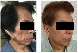 Novel modalities for hair growth & skin repair