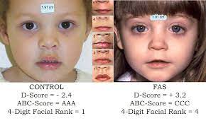 Deciding whether to do a nasally tapered fold that folds into the epicanthal fold, or a parallel crease. Http Depts Washington Edu Fasdpn Pdfs Facebrain Pdf