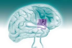 Cva is an adjustment to the fair value (or price) of derivative instruments to account for counterparty thus, cva is commonly viewed as the price of ccr. 11th Annual Stroke And Cerebrovascular Disease Review 2019 Mayo Clinic School Of Continuous Professional Development
