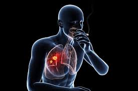 Have more lung infections (like bronchitis and pneumonia) are more likely to cough, wheeze, and have shortness of breath. Smoking And Lung Cancer Lovetoknow
