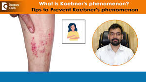 Image result for koebner phenomenon psoriasis