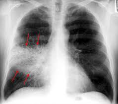 PNEUMONİA radiology ile ilgili görsel sonucu