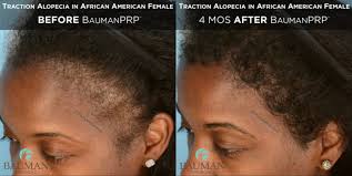 Newish® onion hair oil for hair growth for men & women (black seed/kalonji) controls hair fall & dandruff 200ml. Traction Alopecia In African American Baumanprp Bauman Medical