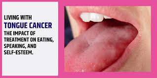 Image result for cancer tongue symptoms)