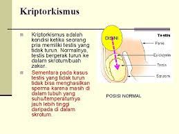 Kepala, midpiece, dan ekor pada 200 spermatozoa. Infertilitas Pada Usia Reproduksi Dan Penanganannya Bambang Hariyadi