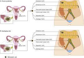 Read on to learn the basics of ovarian cancer, what characterizes stage 1, and who's at risk. The Attributive Value Of Comprehensive Surgical Staging In Clinically Early Stage Epithelial Ovarian Carcinoma A Systematic Review And Meta Analysis Sciencedirect