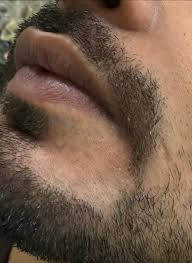 Image result for Beard Dermatitis