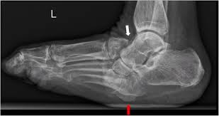 Symptoms may include the following: The Charcot Foot A Pictorial Review Insights Into Imaging Full Text