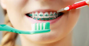 Trattamenti ortodontici della dr.ssa giulia pilat. Pulizia Dispositivi Ortodontici Come Mantenere Una Corretta Igiene Orale Con L Apparecchio