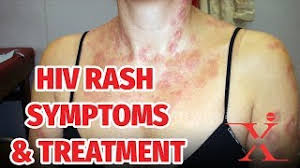 Aids is the most advanced stage of infection. How To Identify Hiv Skin Rashes And How It Can Be Treated Youtube