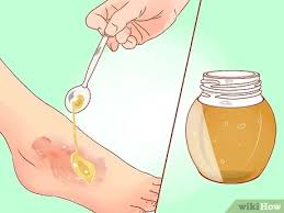 Laughlin says, watch for tenderness or redness in the skin around the blister, or the fluid starting to look like pus. 3 Ways To Treat A Blister Burn Wikihow