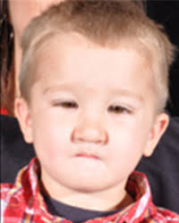 Pierre Robin Sequence Before & After Pictures Dallas, Plano, TX