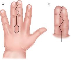 Image result for Syndactyly