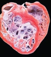 Image result for Left Ventricular Noncompaction